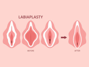 LABIAPLASTY